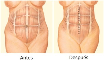 Abdominoplastia2